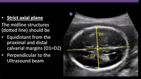 Fetal Lateral Ventricle Measurement Ultrasound