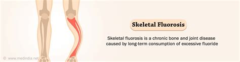 Skeletal Fluorosis - Glossary