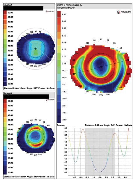 Lesson The Definitive Guide To Corneal Topography