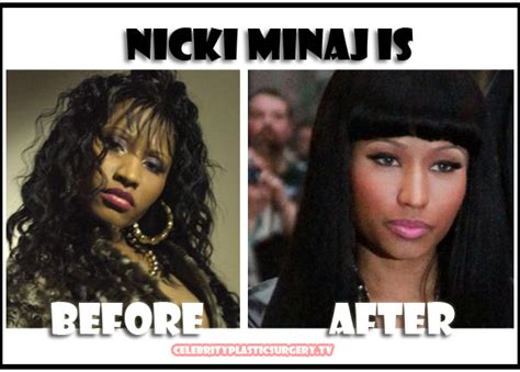 nicki-minaj-plastic-surgery-picture – TheCount.com