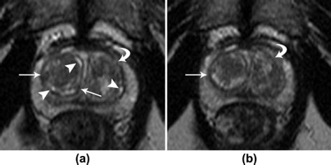 Differentiation Of Transitional Zone Prostate Cancer From Benign