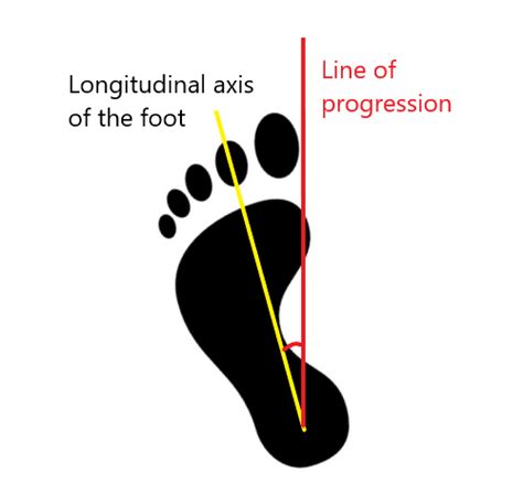 Foot Progression Angle - auptimo