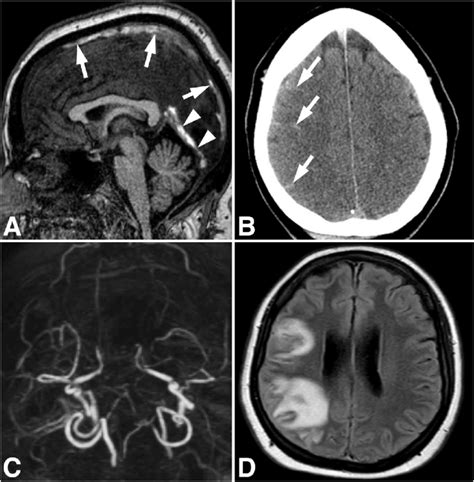 Inferior Sagittal Sinus Mri