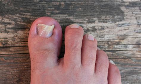 Pourquoi Les Ongles Des Pieds Deviennent Ils Pais Et Comment Le Pr Venir