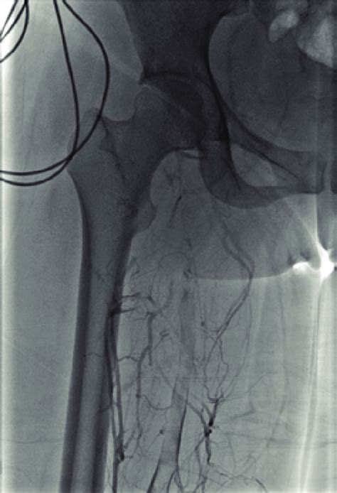 Preintervention Venogram Demonstrating Extensive Thrombus Within The