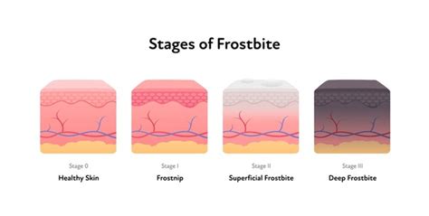 63 Deep Frostbite Images, Stock Photos, 3D objects, & Vectors | Shutterstock