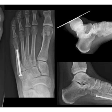 Oblique foot radiograph depicting an os vesalianum, often confused for