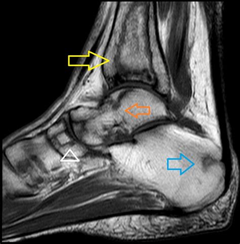 CBR Bradcases ACHADOS DE IMAGEM DE OSTEONECROSE E INFARTO ÓSSEO EM