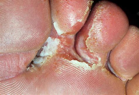 Fungus Between Toes