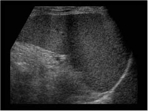 Abdomen and retroperitoneum | 1.1 Liver : Case 1.1.12 Cirrhosis and ...