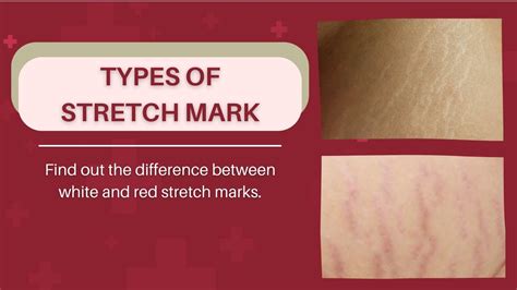 All You Need To Know About Stretch Marks Types Of Stretch Mark On Body