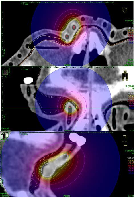 Jpm Free Full Text Personalized Superficial Hdr Brachytherapy