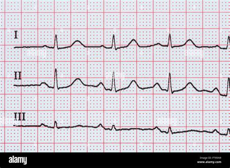 Ekg Normal High Resolution Stock Photography and Images - Alamy