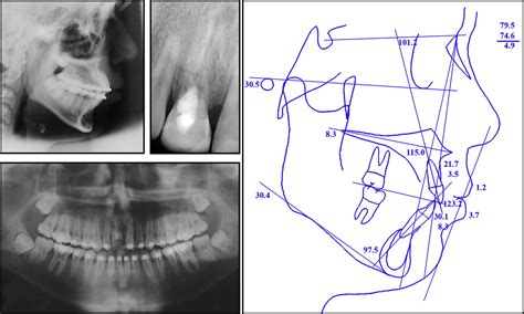 Ankylosed Maxillary Incisor With Severe Root Resorption Treated With A Single Tooth Dento