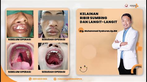 Kelainan Bibir Sumbing And Langit Langit Oleh Drg Muhammad Syakuran Sp