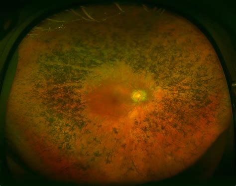 Retinosis pigmentaria qué es y cómo se produce Miranza