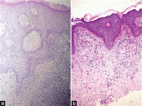 Granulomatous cheilitis with granulomatous vulvitis: A rare association ...