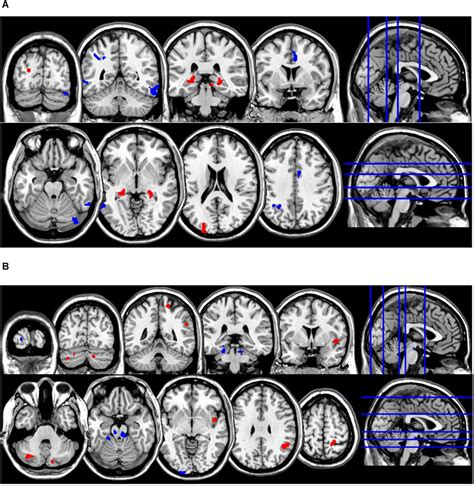 Frontiers Local Neuronal Synchronization In Frequent Nightmare