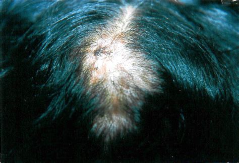 Multifocal Scalp Hair Loss Associated With Metastases Of Breast