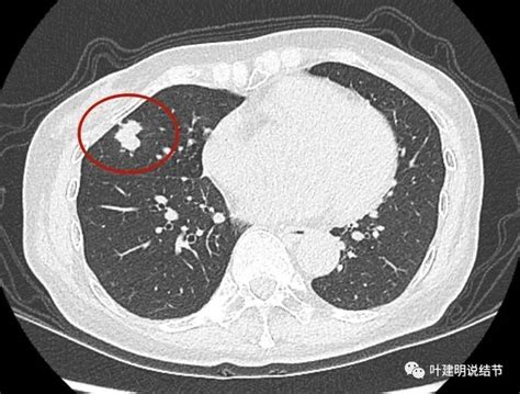 问诊分析（202395）：肺实性占位是不是肺癌，这点最重要！肺实性肺癌影像病灶 健康界