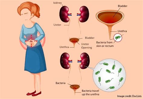 Urinary Tract Infection Not Transmissible Through Sex Sharing Toilet Physician Healthwise