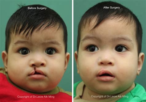 Cleft Lips Before And After Surgery | Lipstutorial.org