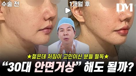 30대에 안면거상 해도 괜찮을까 안면거상 리프팅 중년안면거상 Youtube