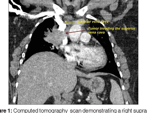 Figure 1 From Superior Vena Cava Syndrome Due To Metastasis From Acinic