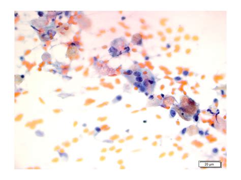 Figure Multi Nucleated Giant Cell Pap Stain At X Asc Education