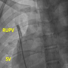 Cardiac Catheterization Showed Scimitar Vein Draining To The IVC