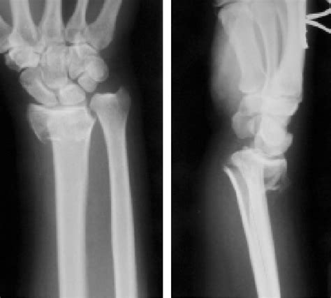 Pdf Volar Fixation Of Dorsally Displaced Distal Radial Fracture Using Locking Compression