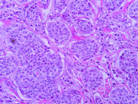 Adenocarcinoma Nos Histopathology Guru