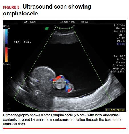 When Ultrasonography Reveals A Fetal Abdominal Wall Defect MDedge ObGyn