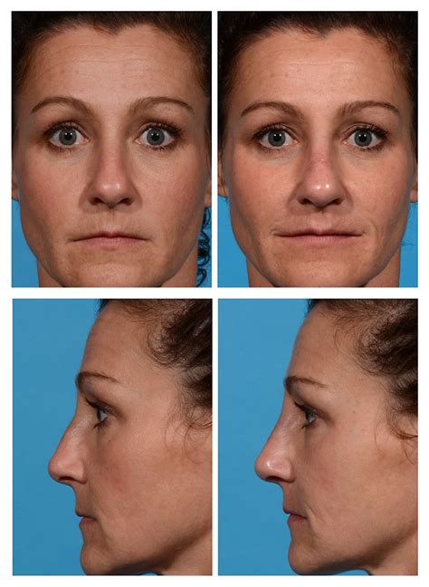 Revision Rhinoplasty Before And After Photos