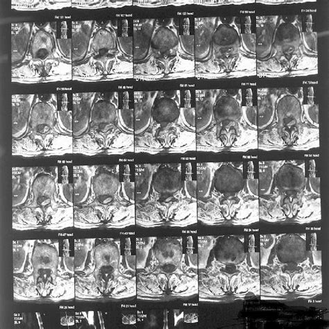 Magnetic Resonant Imaging Thoracolumbar Spine Showing Epidural