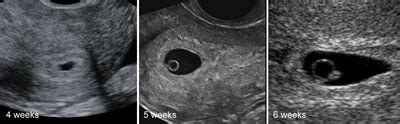 Week Gestational Sac Ultrasound