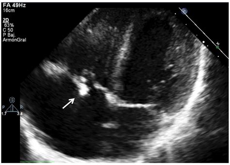 Jcm Free Full Text Pediatric Infective Endocarditis A Literature