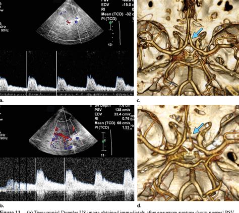 Figure From Advances In Transcranial Doppler Us Imaging Ahead