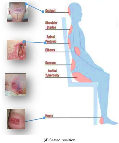 Healthcare Free Full Text Yolo Based Deep Learning Model For Pressure Ulcer Detection And