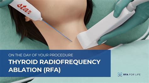 Thyroid Radiofrequency Ablation Rfa On The Day Of Your Procedure