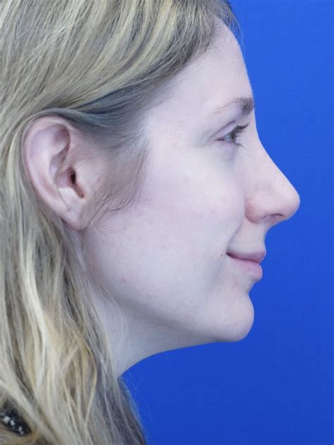 Cases In Rhinoplasty External Page 2 Of 4 Mao Facial Plastics