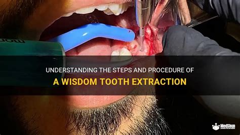 Understanding The Steps And Procedure Of A Wisdom Tooth Extraction