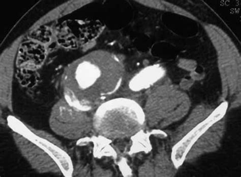 CT-scan of the 5.5 cm AAA with intraluminal thrombus. Fig. 7. CT-scan ...