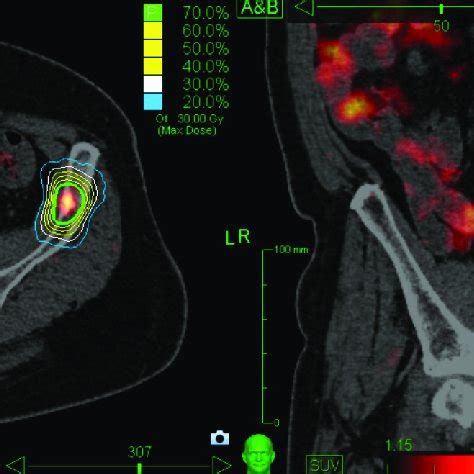 PSMA PET CT Based Radiotherapy Treatment Plan Of CyberKnife Treatment