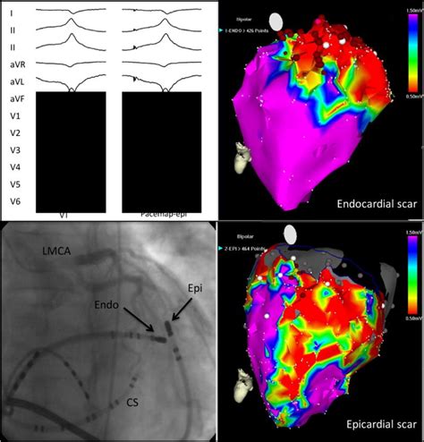 Epicardial Interventions In Electrophysiology Abstract Europe Pmc