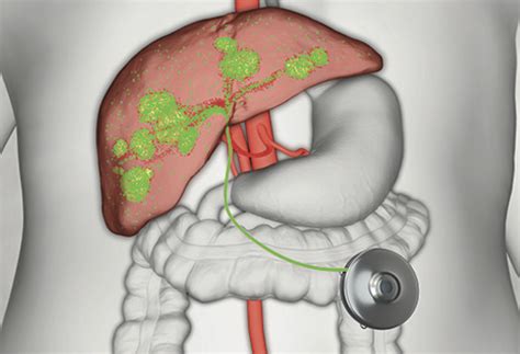 Hepatic Artery Infusion Pump Therapy – Jesse Sulzer MD PhD