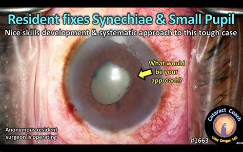 1663 Resident Synechiae Cataract Coach™