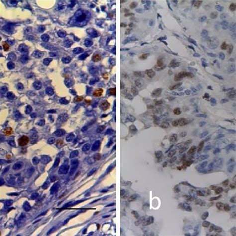 IHC staining for Ki 67 a and ERα b showing nuclear staining in