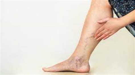 Everything You Need To Know About Chronic Venous Insufficiency