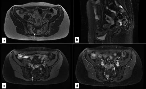 Case 1 A Axial T1 Pelvis Mri Demonstrating A T1 Hypointense Lesion Download Scientific